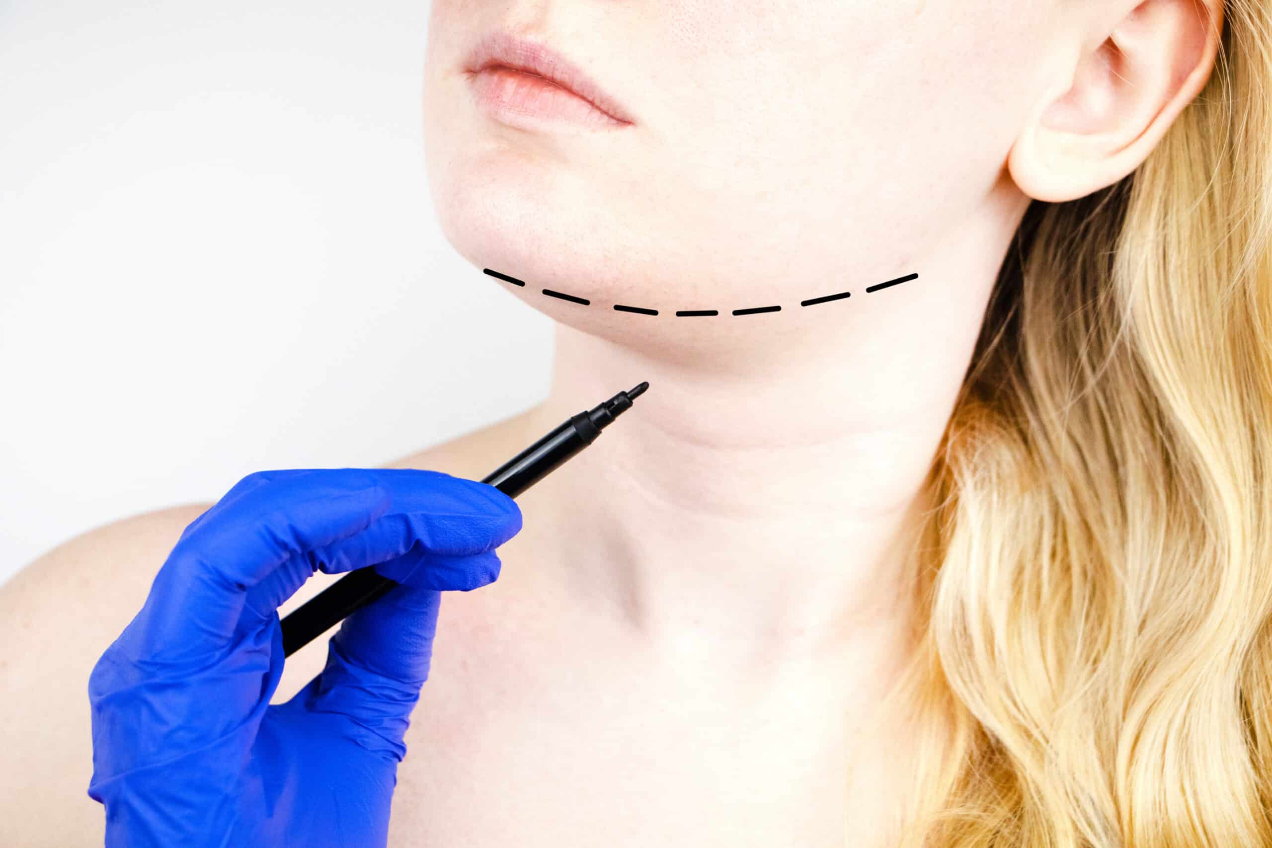 How Chin Surgery Can Complement Rhinoplasty for the Perfect Profile