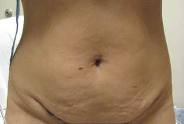 Tummy Tuck before and after photos
