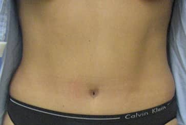 Abdominoplasty — after