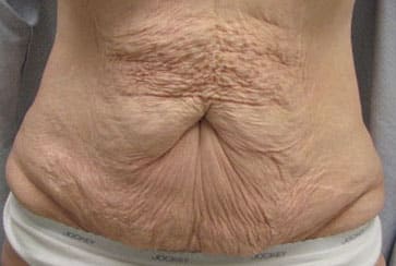 Abdominoplasty — before