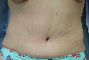 Abdominoplasty — after