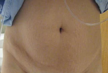 Abdominoplasty — before