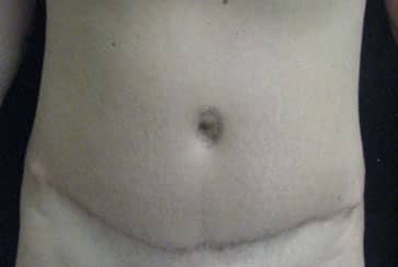 Abdominoplasty — after