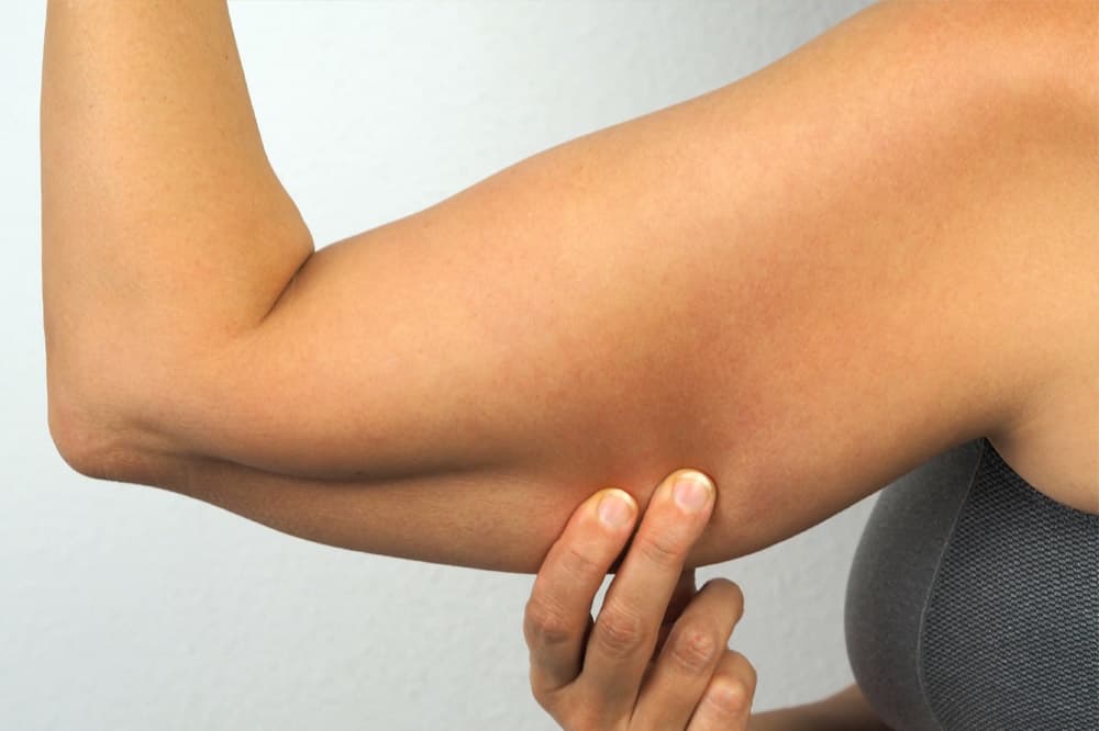 Brachioplasty (Arm Lift) before and after gallery