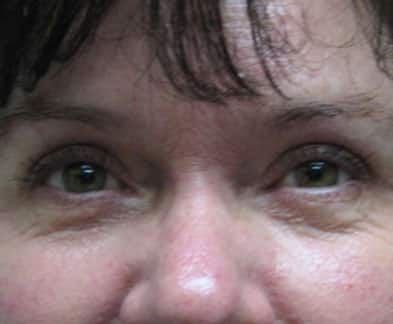 Blepharoplasty (Eyelid Surgery) — after