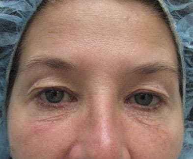 Blepharoplasty (Eyelid Surgery) — before