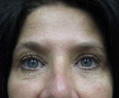 Blepharoplasty (Eyelid Surgery) — after