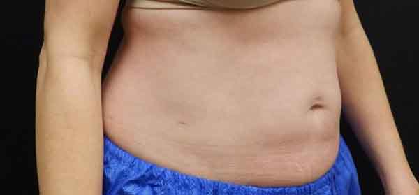 Body Procedures — after