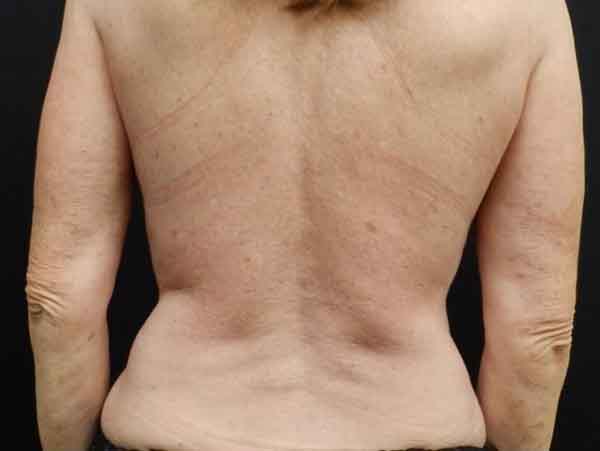Body Procedures — after