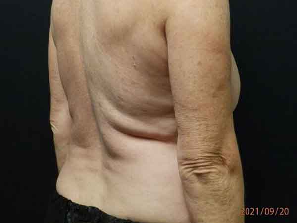 Body Procedures — before