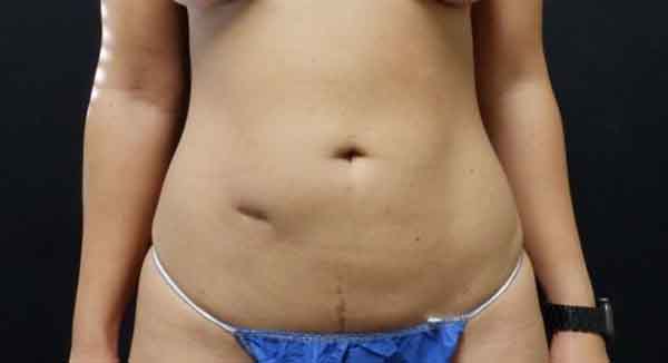 Body Procedures — after