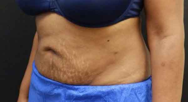 Body Procedures — after