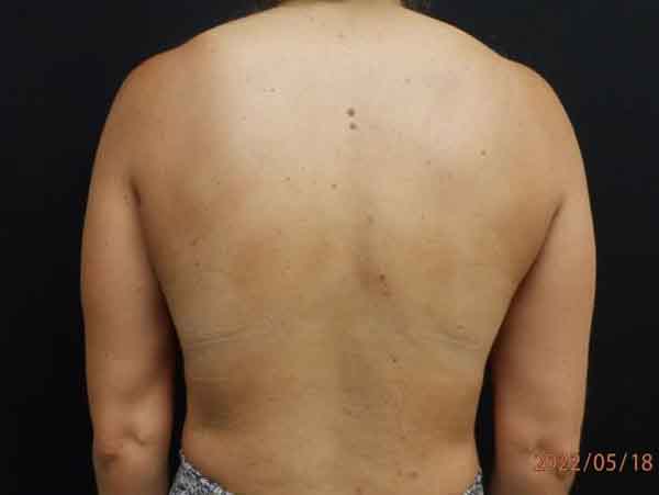 Body Procedures — before