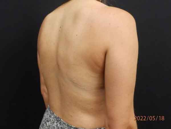Body Procedures — before