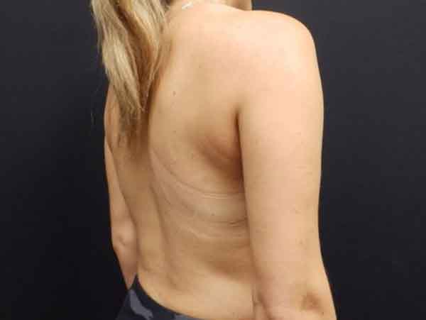Body Procedures — after