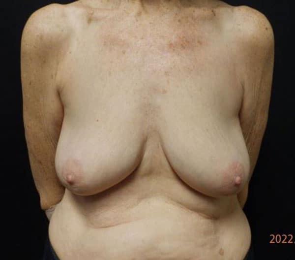 Body Procedures — before