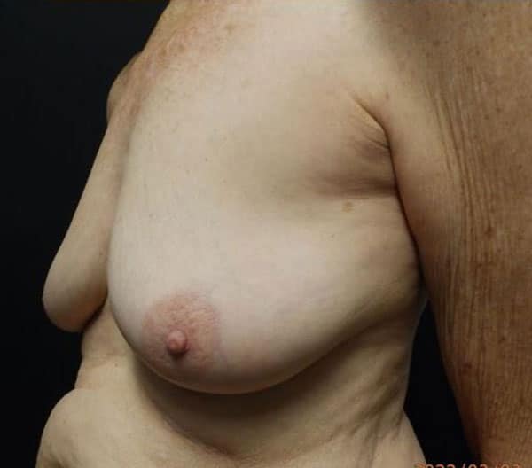 Body Procedures — before