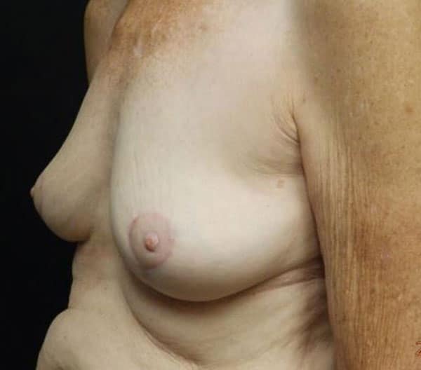 Body Procedures — after