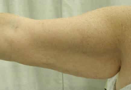 Arm Lift before and after photos