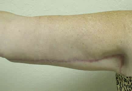 Brachioplasty (Arm Lift) — after