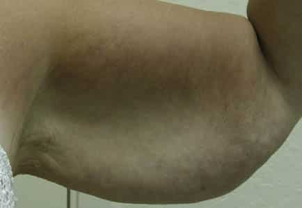 Brachioplasty (Arm Lift) — before