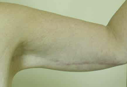 Brachioplasty (Arm Lift) — after