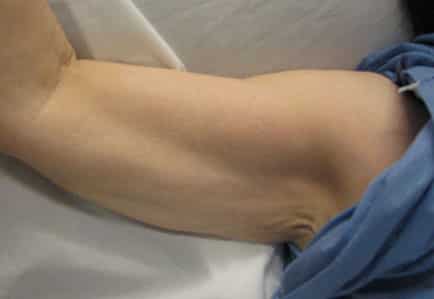 Brachioplasty (Arm Lift) — before