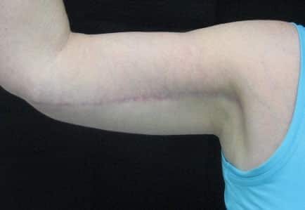 Brachioplasty (Arm Lift) — after