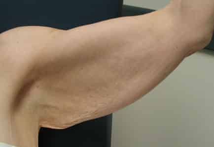 Brachioplasty (Arm Lift) — before