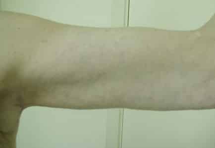 Brachioplasty (Arm Lift) — after