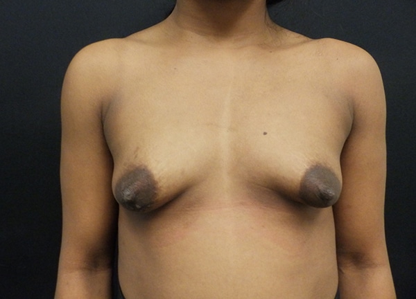 Breast Augmentation before and after photos