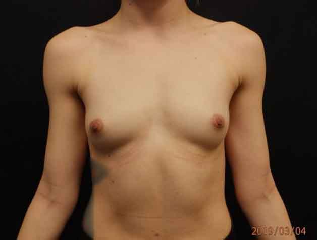 Breast Augmentation — before