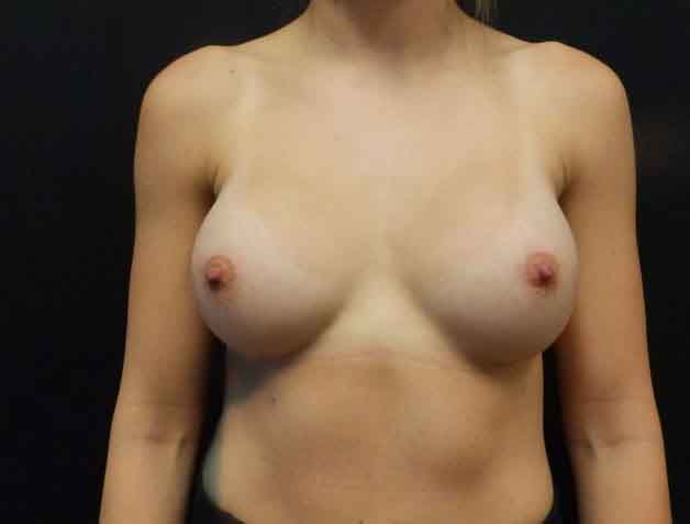 Breast Augmentation — after