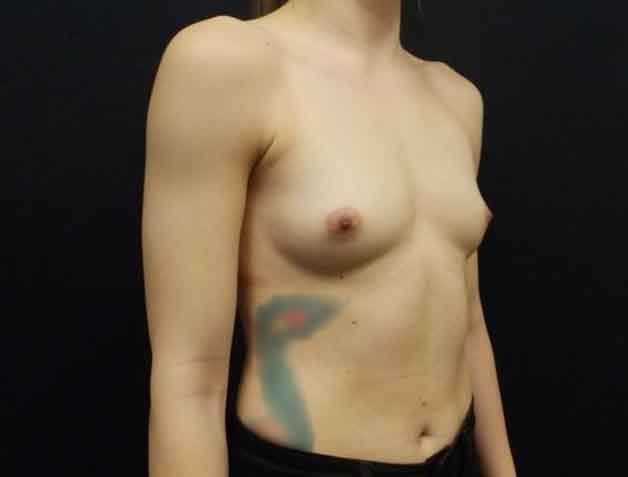 Breast Augmentation — before