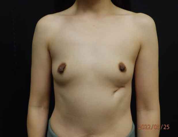 Breast Augmentation — before