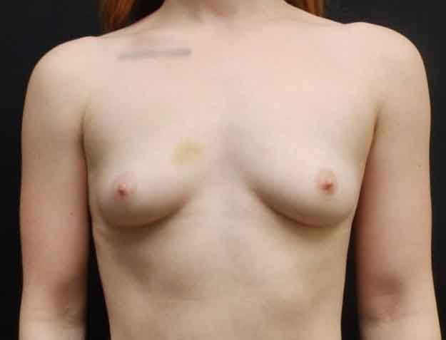 Breast Augmentation — before