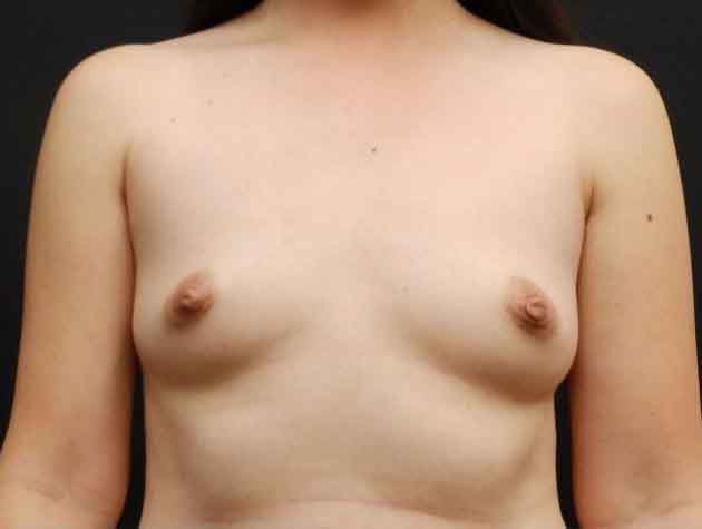 Breast Augmentation — before