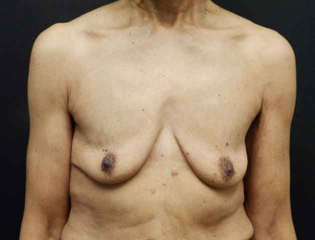 Breast Augmentation — before