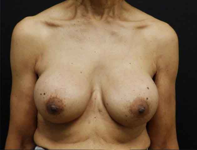 Breast Augmentation — after