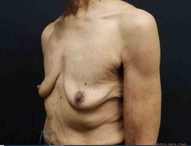 Breast Augmentation — before