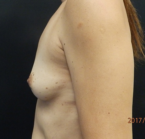 Breast Augmentation — before