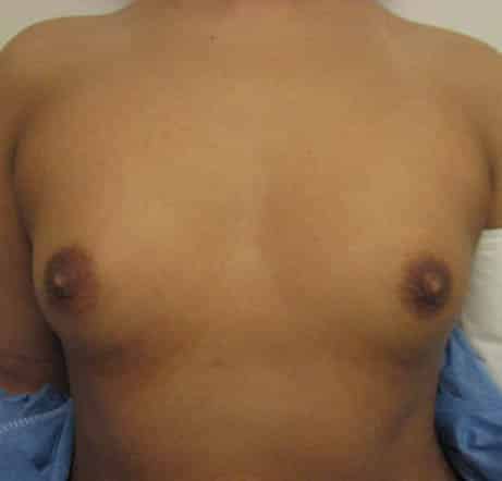 Breast Augmentation — before