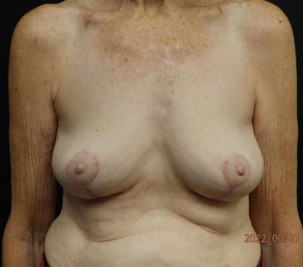 Breast Lift (Mastopexy) — after