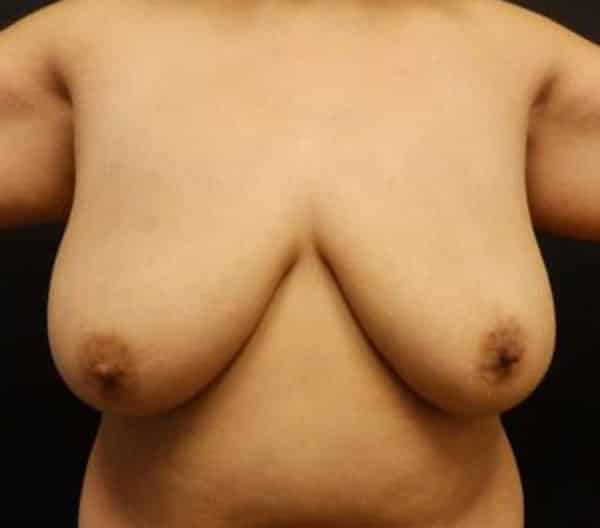 Breast Lift (Mastopexy) — before