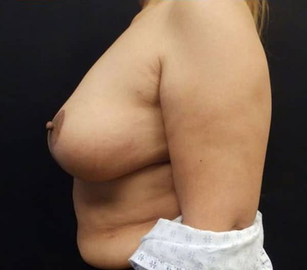 Breast Lift (Mastopexy) — after