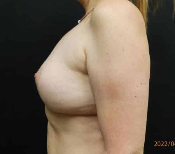 Breast Lift (Mastopexy) — after