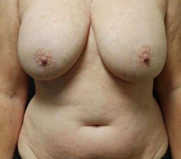 Breast Lift (Mastopexy) — before