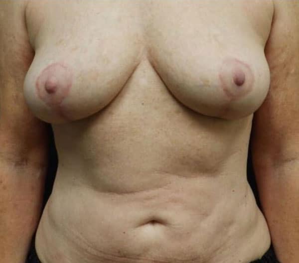 Breast Lift (Mastopexy) — after