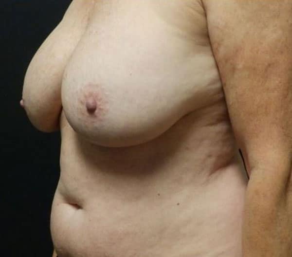 Breast Lift (Mastopexy) — before