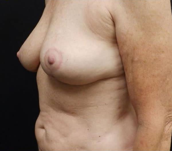 Breast Lift (Mastopexy) — after